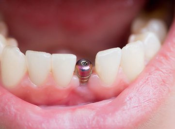 Close-up of a dental implant in Allen, TX without restoration