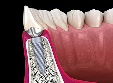 Illustration of dental implant in Allen, TX bonded with the jawbone