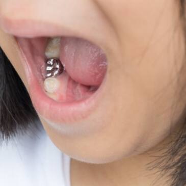 Close up of a child's mouth with silver on one tooth