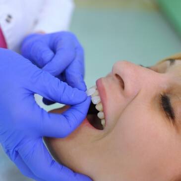 Dentist holding a veneer over a patient's tooth