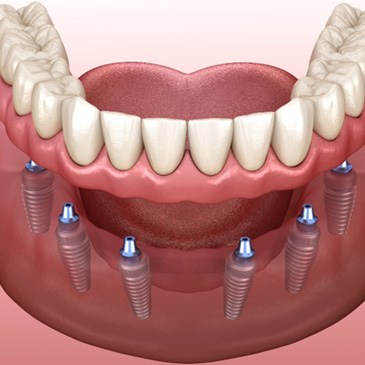 Implant dentures in Allen 