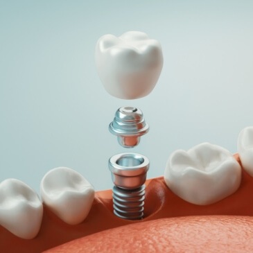Animated dental implant in Allen with abutment and crown in the lower jaw
