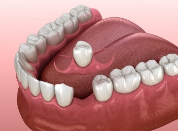 Animated dental crown being placed in empty space between two teeth