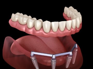 Animated implant denture supported by four dental implants