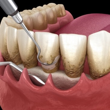 Animated close up of teeth and gums during gum disease therapy