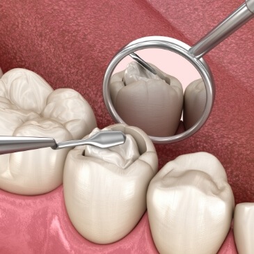 Animated close up of tooth colored filling being placed in a tooth